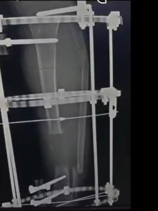 صورة شعاعية للساق بعد تعديل التشوه واستئصال العظم الملتهب بجهاز الإليزاروف