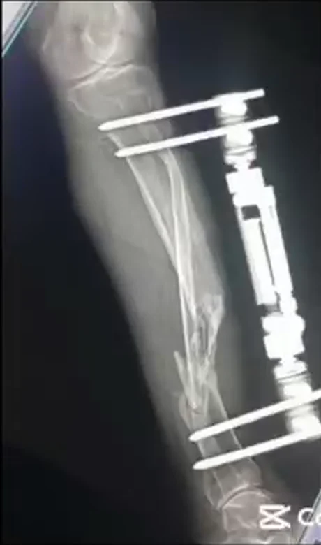 صورة شعاعية للساق بعد إصابة حرب مع تشوه والتهاب في العظم قبل العملية