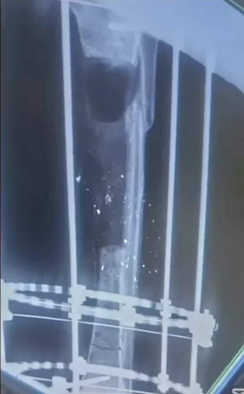 صورة شعاعية لعظم الساق بعد إصابة حرب مع ضياع جزء كبير من العظم