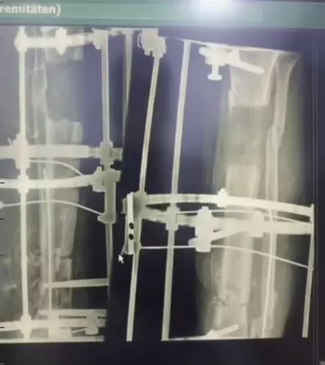 صورة شعاعية بعد نقل العظم بجهاز الإليزاروف والتعويض الكامل عن العظم الناقص