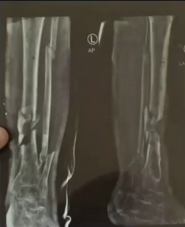 صورة شعاعية لكسر مفتت في الساق بعد حادث مروري