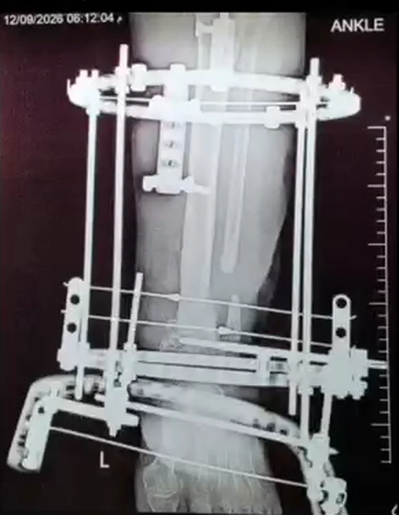 صورة شعاعية بعد إرجاع الكسر بجهاز الإليزاروف