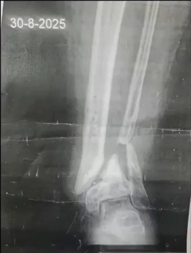صورة شعاعية لكسر غير ملتحم بأسفل الساق
