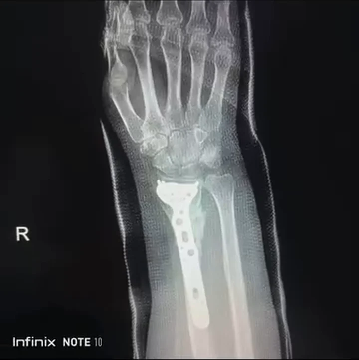 صورة شعاعية بعد تبديل الصفيحة وزراعة طعم عظمي